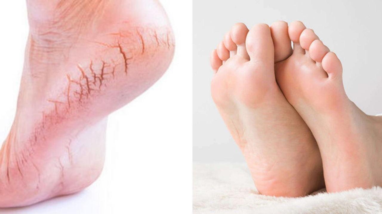 செலவே இல்லாம குதிகால் வெடிப்பு சுலபமா போக இதை ட்ரை பண்ணுங்க...