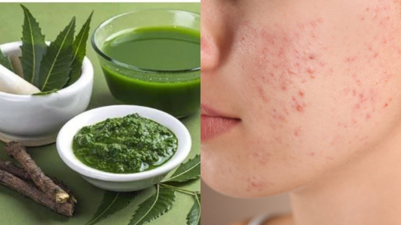 வேப்பிலையை இப்டி யூஸ் பண்ணா எப்படிப்பட்ட முகப்பரு பிரச்சனையையும் சரி செஞ்சுடலாம்...